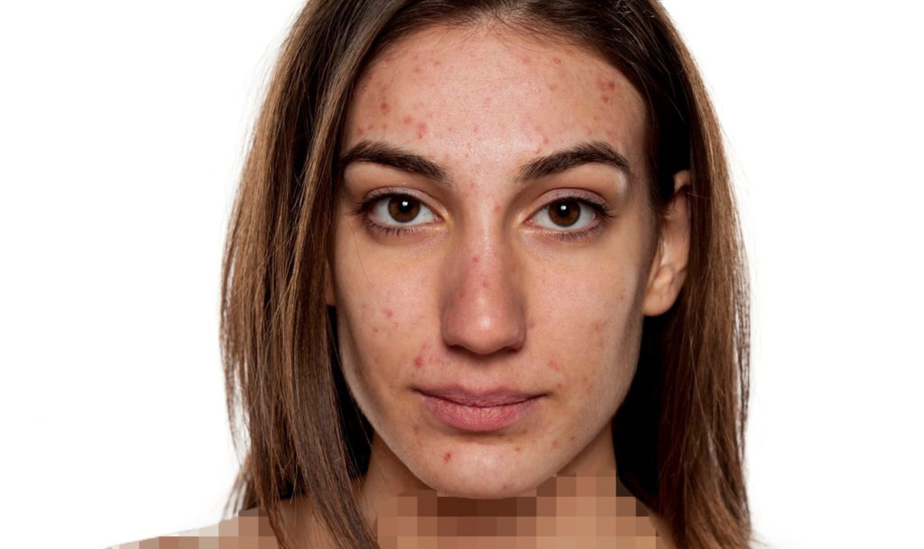 برندهای ضد جوش صورت