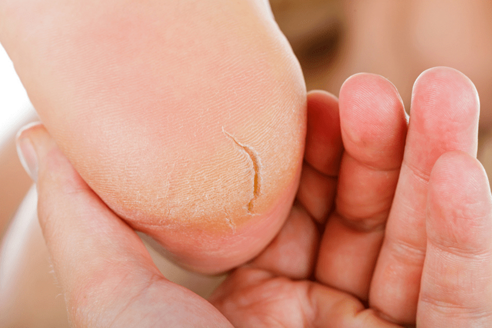 برندهای کرم پا