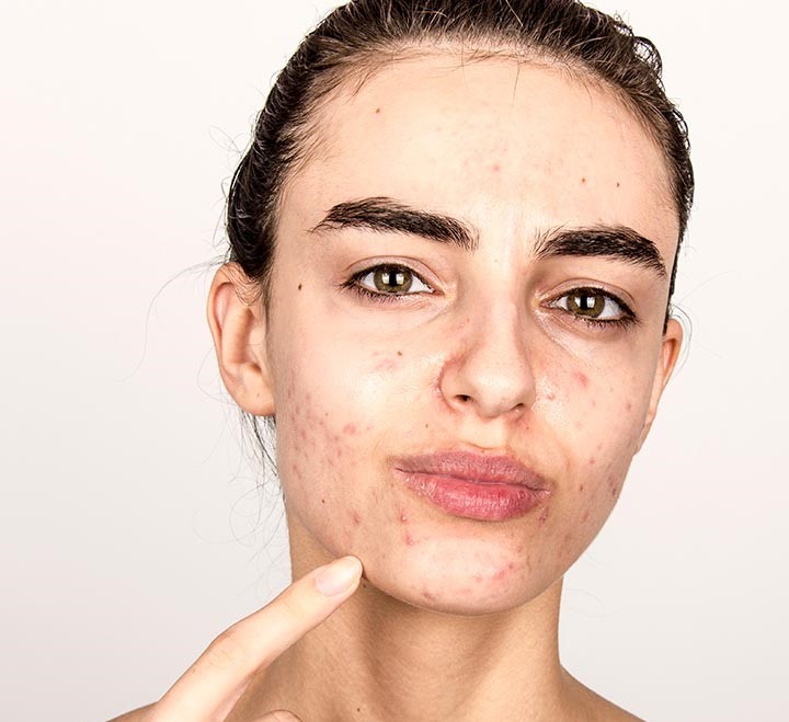 برندهای ضد جوش صورت