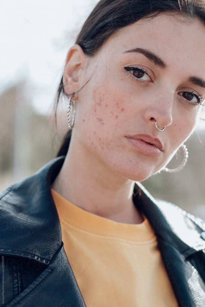 برندهای ضد جوش صورت