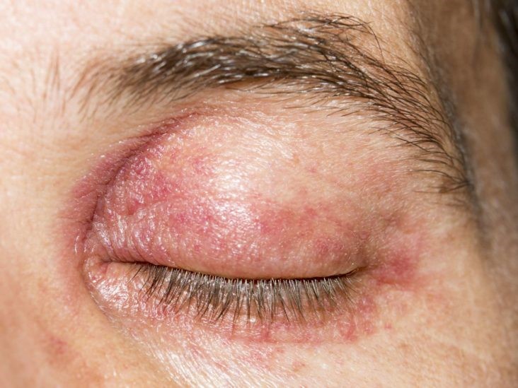 نشانه های حساسیت پوست به کرم دور چشم